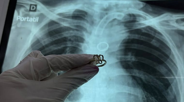 El objeto habría estado alojado unos 6 meses. Foto: Gentileza