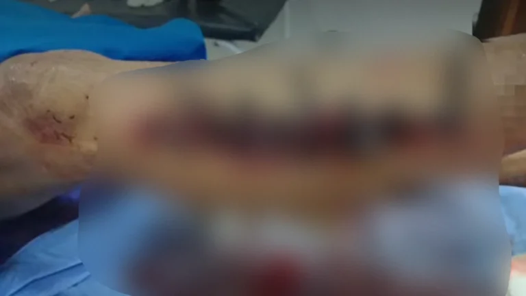 La herida del adulto mayor fue suturada con cintillo de plástico y generó indignación.